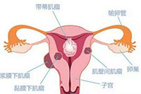 了解子宫腺肌病的症状很有必要
